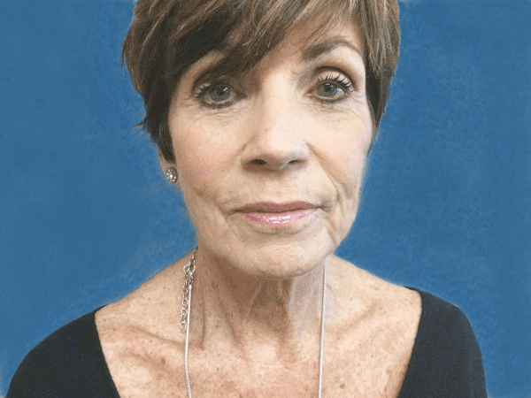 Mohs Nose Patient 18 After - 2