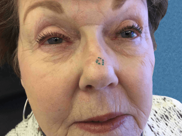 Mohs Nose Patient 19 Before