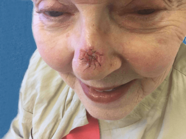 Mohs Nose Patient 19 Before - 2