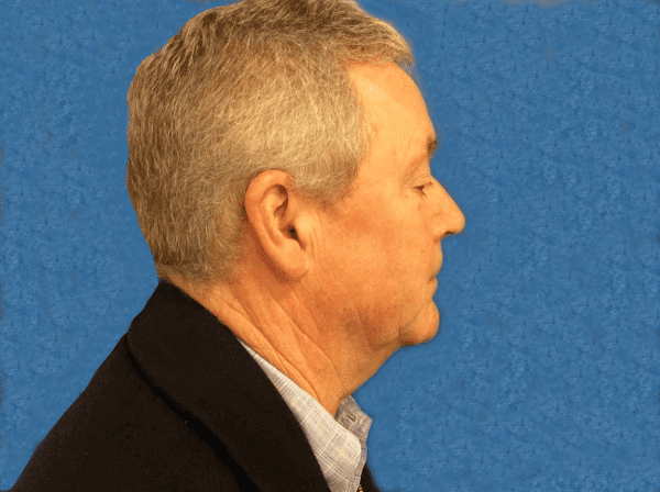 Facelift patient 04 After