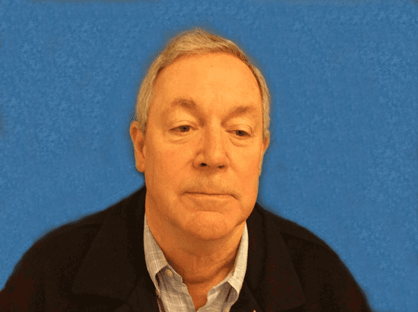 Facelift patient 04 Before