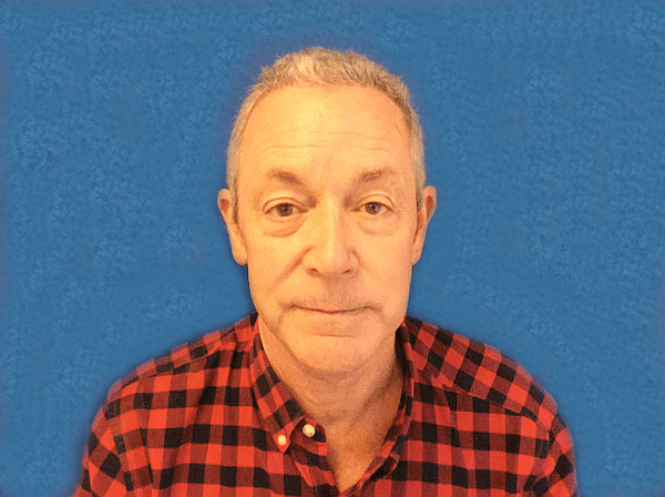 Facelift patient 04 Before - 2