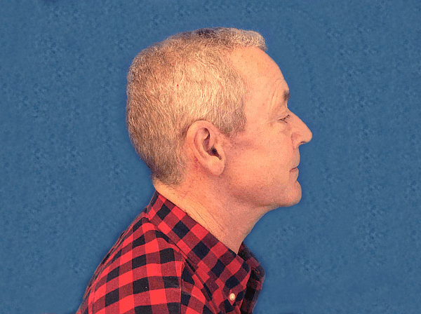 Facelift patient 04 After - 2