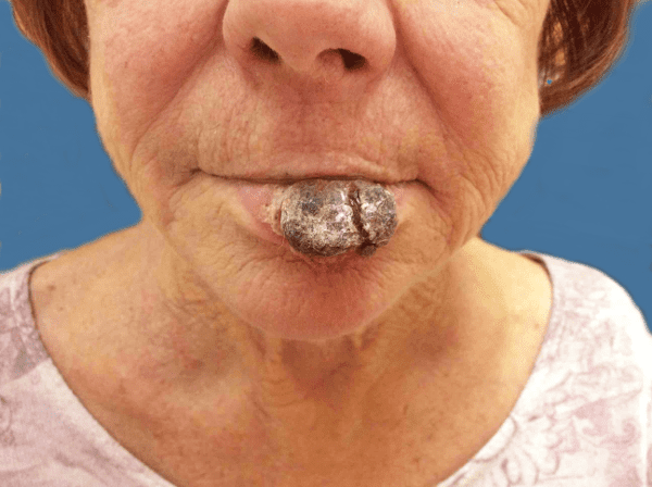 Mohs Lips Patient 07 Before