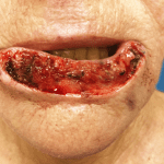 Mohs Lips Patient 07 Thumbnail After