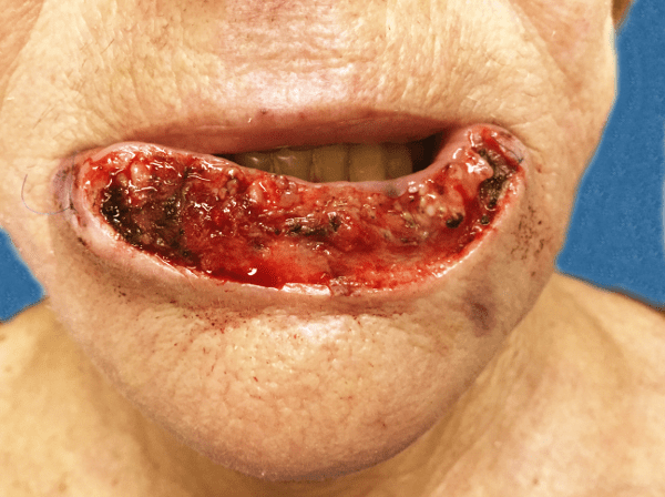 Mohs Lips Patient 07 After