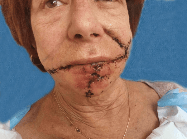 Mohs Lips Patient 07 Before - 2