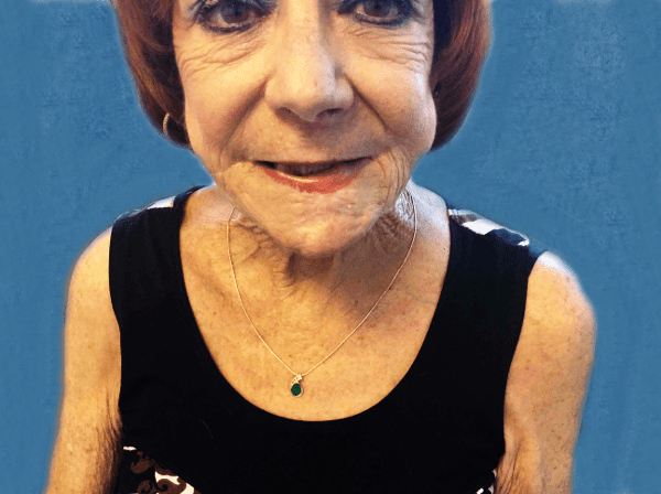 Mohs Lips Patient 07 After - 2