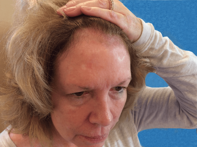 Mohs Face Patient 03 Before