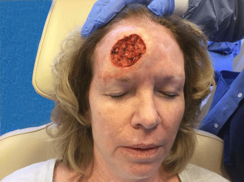 Mohs Face Patient 03 After