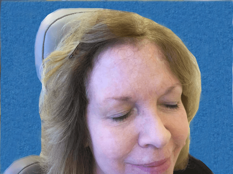 Mohs Face Patient 03 After - 2