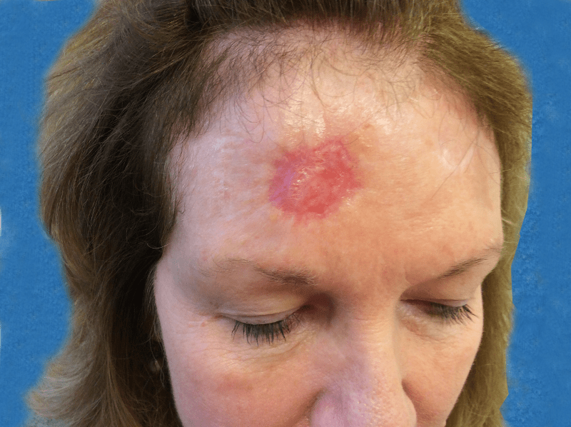 Mohs Face Patient 03 Before - 2