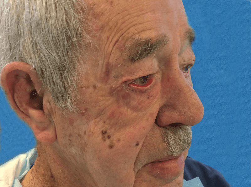 Mohs Eye Patient 02 Before