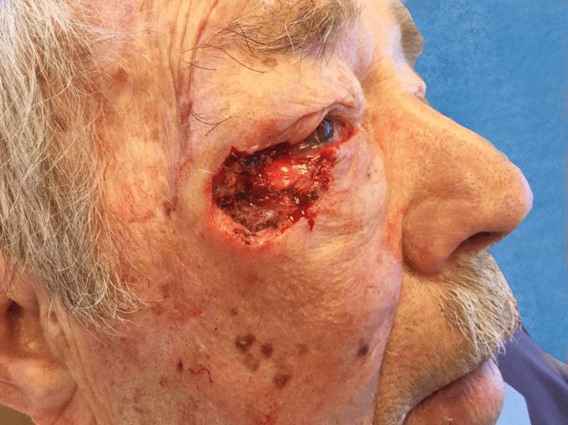 Mohs Eye Patient 02 After