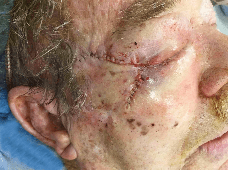 Mohs Eye Patient 02 Before - 2