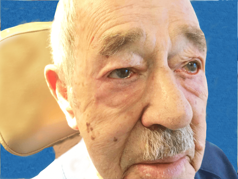 Mohs Eye Patient 02 After - 2