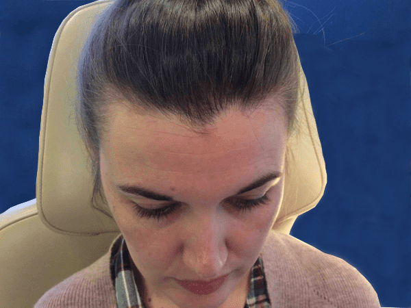 Mohs Face Patient 02 Before