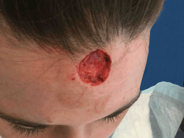 Mohs Face Patient 02 After