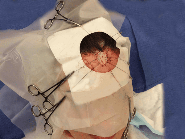 Mohs Face Patient 02 Before - 2