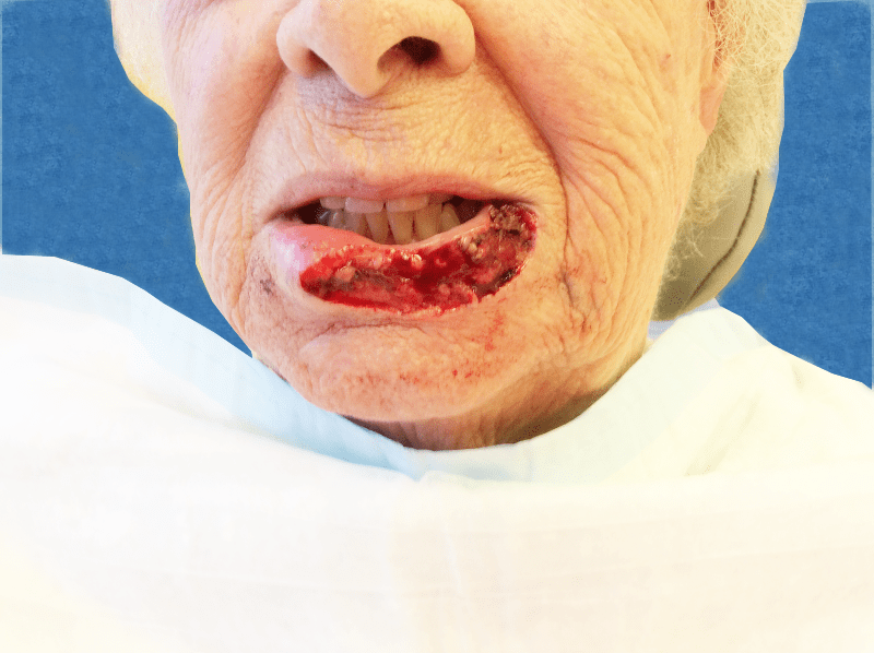 Mohs Lips Patient 08 After