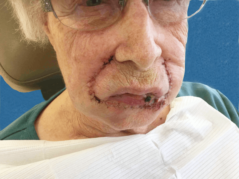 Mohs Lips Patient 08 Before - 2