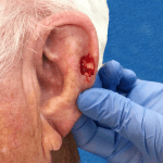 Mohs Ear Patient 06 Thumbnail After