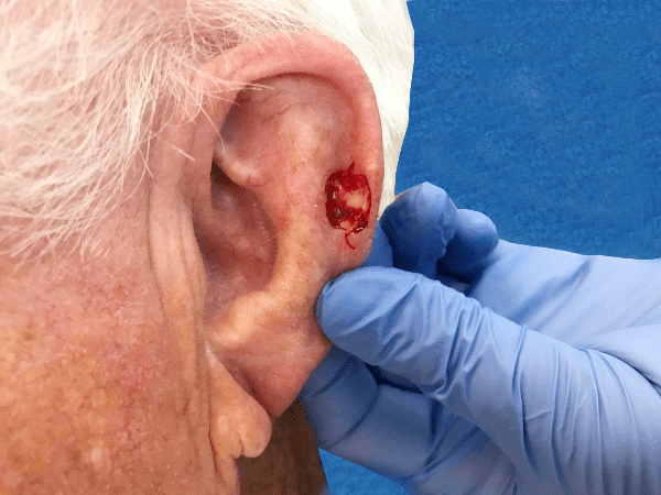 Mohs Ear Patient 06 After