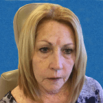 Mohs Face Patient 04 Thumbnail Before