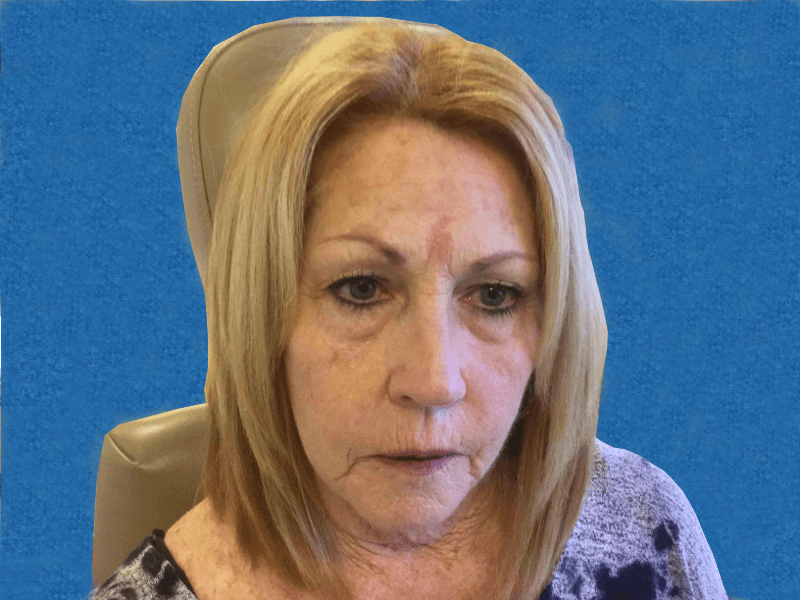 Mohs Face Patient 04 Before