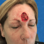 Mohs Face Patient 04 Thumbnail After