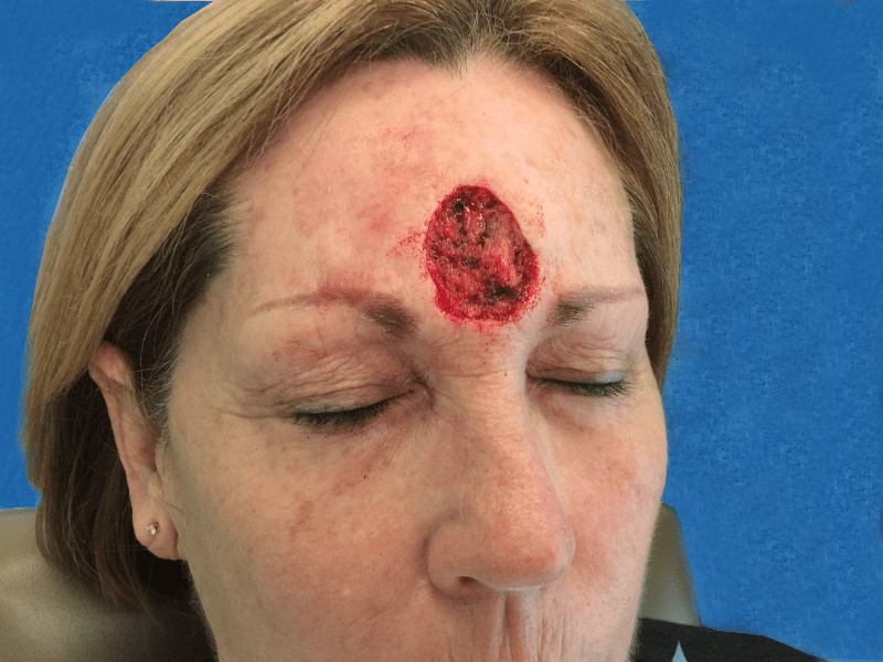 Mohs Face Patient 04 After