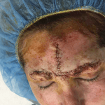 Mohs Face Patient 04 Thumbnail Before - 2