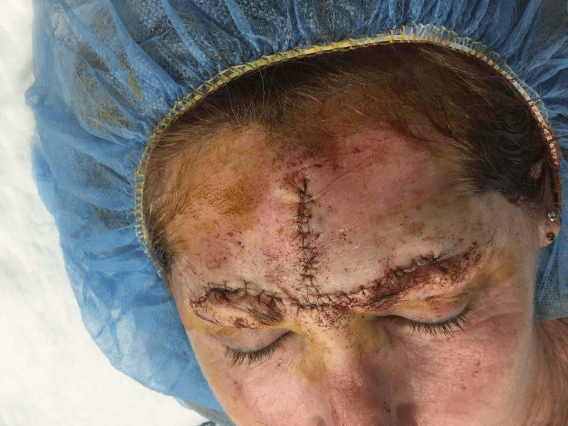 Mohs Face Patient 04 Before - 2