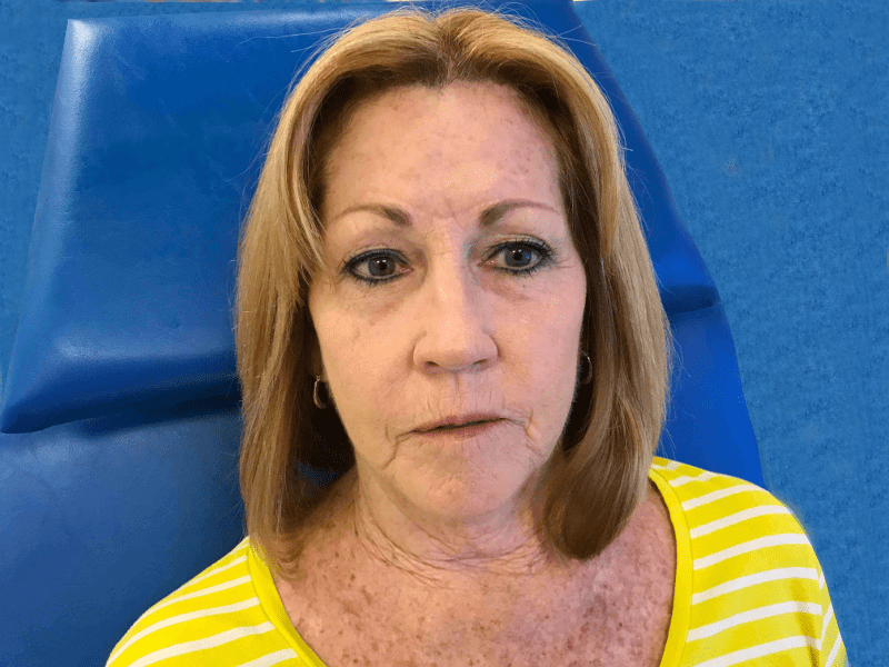 Mohs Face Patient 04 After - 2