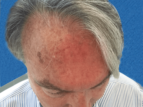 Mohs Face Patient 06 Before