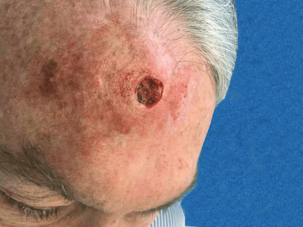 Mohs Face Patient 06 After