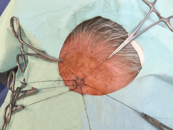 Mohs Face Patient 06 Before - 2