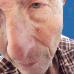 Mohs Face Patient 05 Thumbnail Before