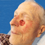 Mohs Face Patient 05 Thumbnail After