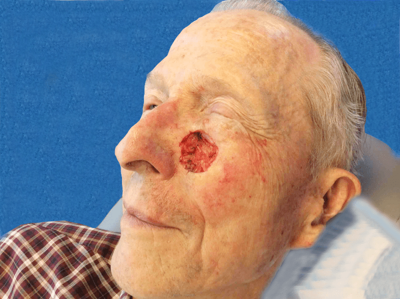 Mohs Face Patient 05 After