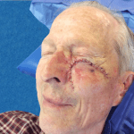 Mohs Face Patient 05 Thumbnail Before - 2