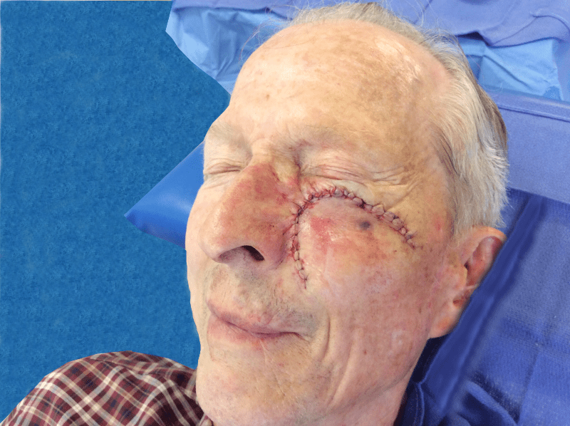Mohs Face Patient 05 Before - 2