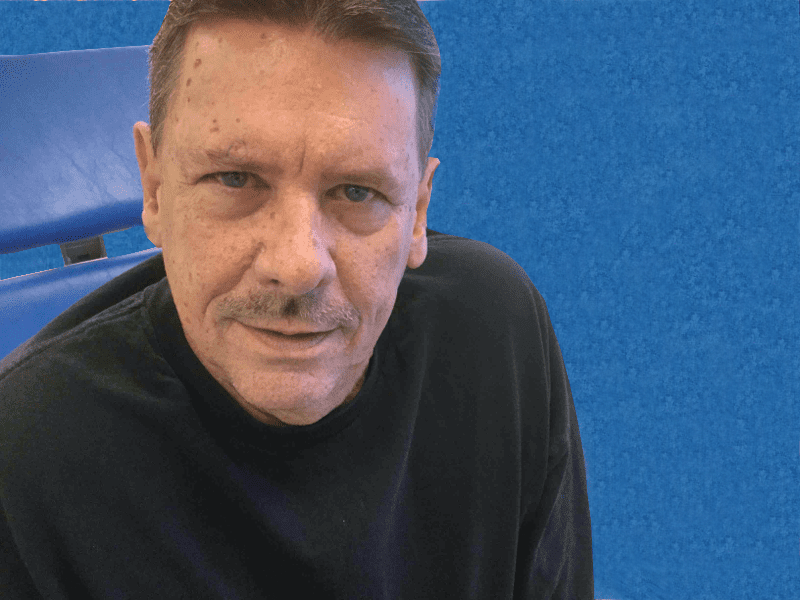 Mohs Face Patient 07 Before