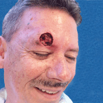 Mohs Face Patient 07 Thumbnail After