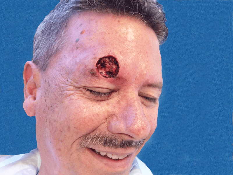 Mohs Face Patient 07 After