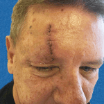 Mohs Face Patient 07 Thumbnail Before - 2