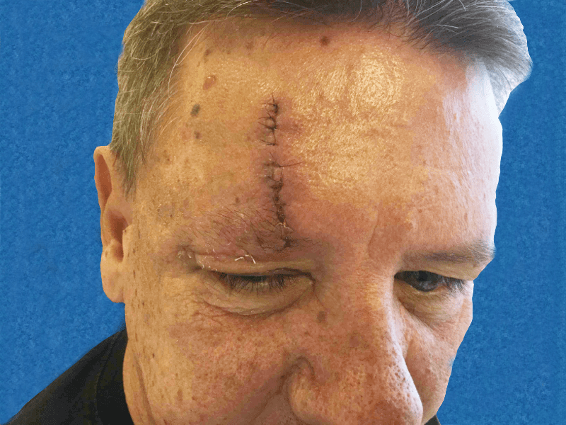 Mohs Face Patient 07 Before - 2