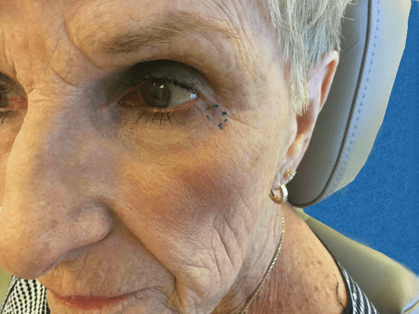 Excision Eye Patient 03 Before