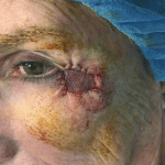 Excision Eye Patient 03 Thumbnail After