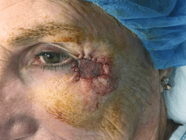 Excision Eye Patient 03 After